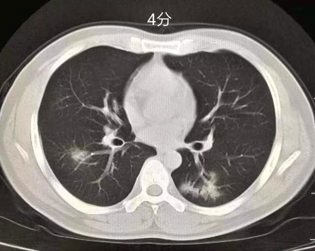 肺部发炎ct图片图片