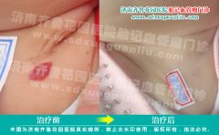 Ѫ������ʲôҩ�ȽϺ�