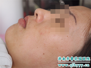 二氧化碳激光治疗仪治疗色素痣前