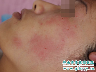 二氧化碳激光治疗色素痣后