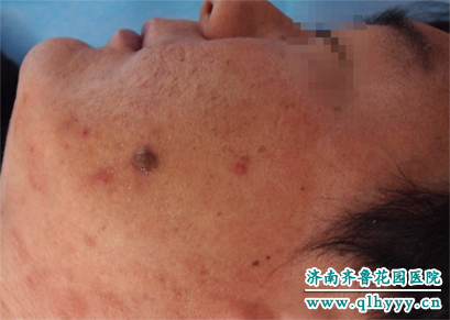 激光治疗皮脂腺瘤前