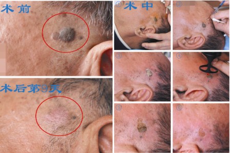 点阵激光治疗皮脂腺痣前后对比