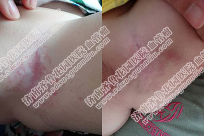 美国技术·四联阶梯疗法的确疗效显著。很快孩子的瘤体就没有那么明显了 图片