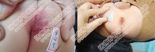 全部疗程结束之后,小涛恢复了健康,肛门的瘤体完全消失,红肿一点也看不出来了 图片