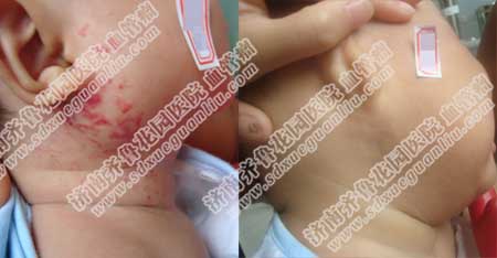 美国技术·四联阶梯疗法是根据患儿具体病情1对1诊断治疗的一整套健康科学疗法,完全摈弃以往治疗血管瘤方法的种种弊端,开创了灵活运用、综合治疗的方法,不破坏表皮和正常组织,只对病变部位产生作用,让血管瘤无从遁形,治疗更彻底不复发,治疗更安全不留疤,没有任何副作用,能够明显减少治疗次数,降低治疗费用,让血管瘤患者轻轻松松地重获健康。