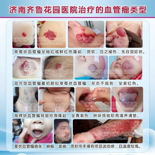 您知道我们为什么举办先治病后交钱,给您想要的疗效的大型治疗血管瘤公益活动吗,婴幼儿血管瘤不可以不治疗,婴幼儿血管瘤被误诊误治最大的关键所在就是治疗血管瘤的方法选择不当。
